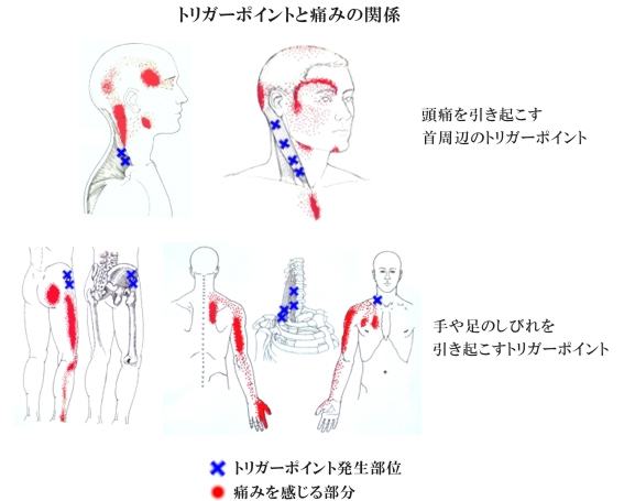 トリガーポイント治療解説 効果 新宿で整体なら代々木あおいカイロプラクティック